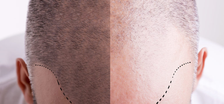 Behandlung von Haarausfall im Saarland