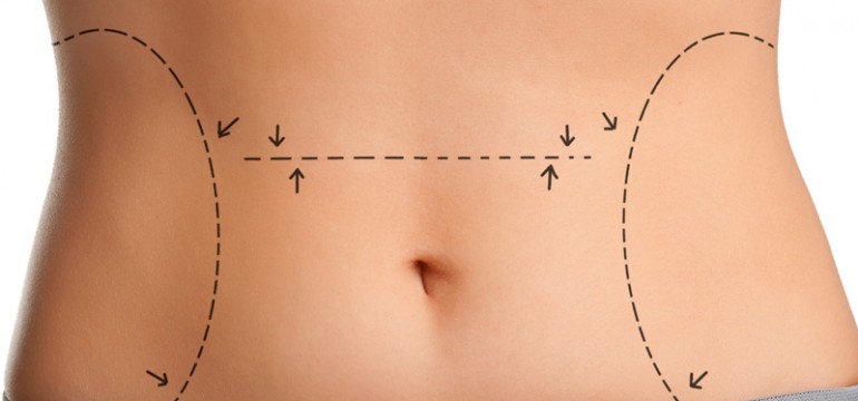 Lokale Fettreduktion im Saarland