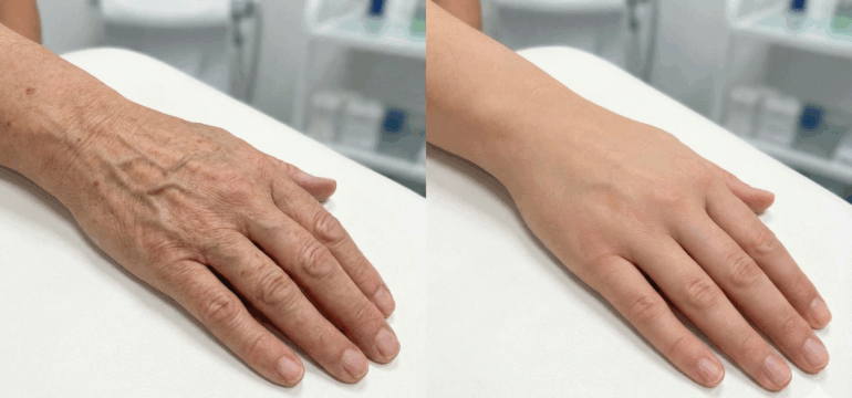 Handrückenglättung